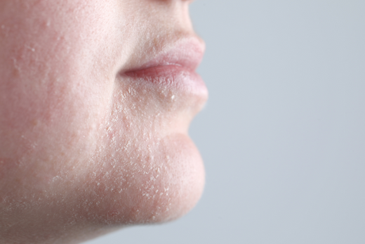 皮膚底層缺水很困擾?皮膚缺水症狀、原因和保養方法